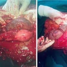 What To Know Before Choosing Uterine Fibroid Embolization What To Know Before Choosing Uterine Fibroid Embolization