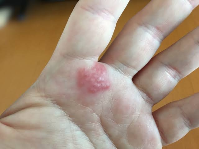 Emergency Room Resources for Managing Allergic Reactions