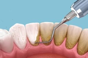 Gum Treatments For Patients With Sensitive Gums
