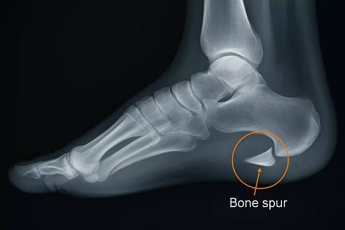 Understanding How a Podiatrist Diagnoses Heel Spurs
