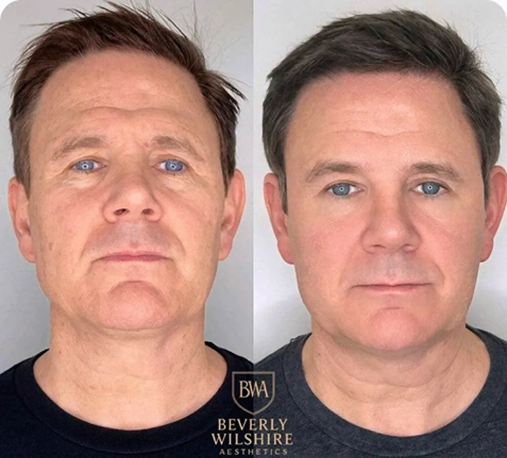 Understanding the Benefits of Blepharoplasty